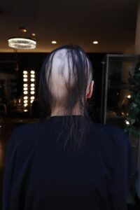 Woman with alopecia before image in Stanwood, Washington