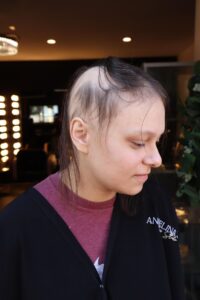 Woman with alopecia before image in Stanwood, Washington